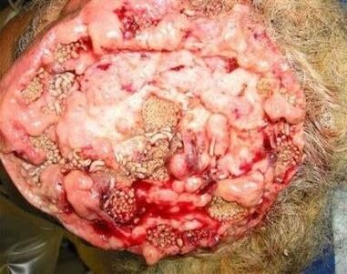 parásitos en el cerebro humano